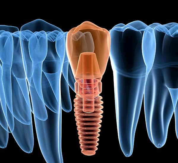 IMPLANTES DENTALES