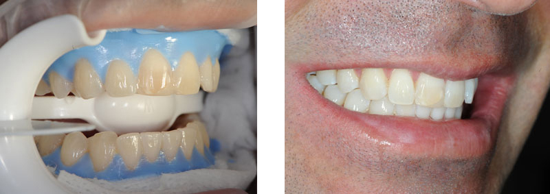 Blanqueamiento dental Sevilla